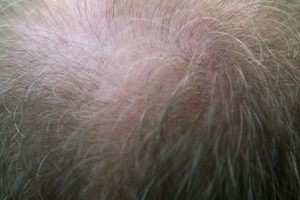 alopecia androgenetica da Chimicamo